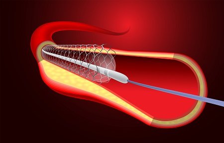 Coronary Angioplasty