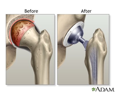 Hip Replacement